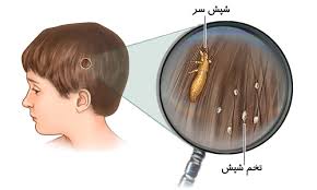 تخم شپش
